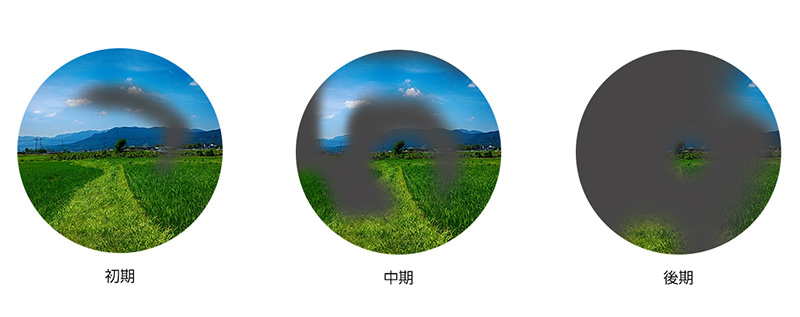 緑内障専門外来