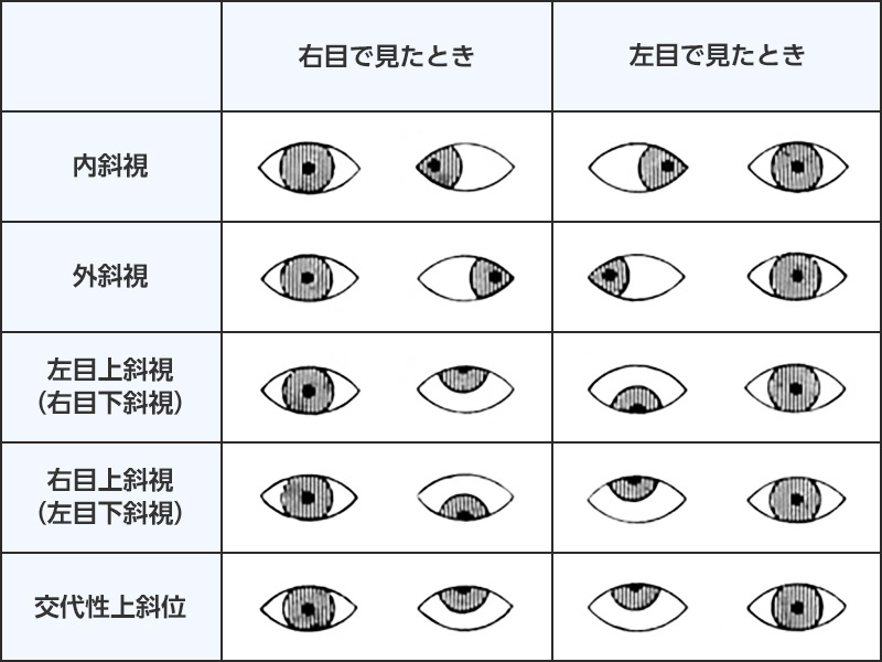 斜視の種類