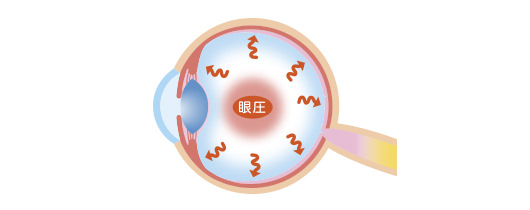 緑内障手術