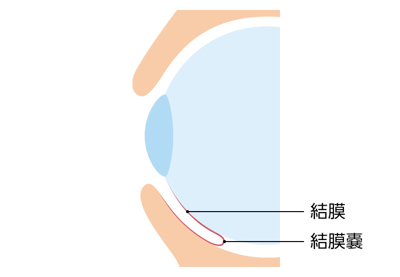 結膜弛緩症手術