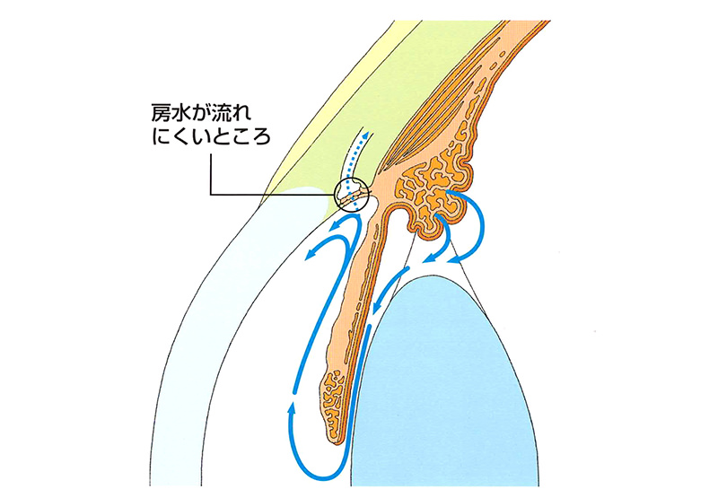 緑内障手術