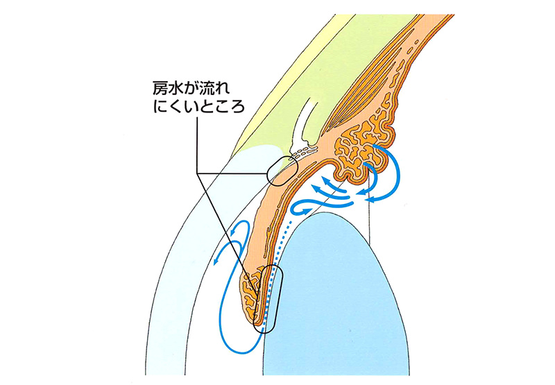 緑内障手術