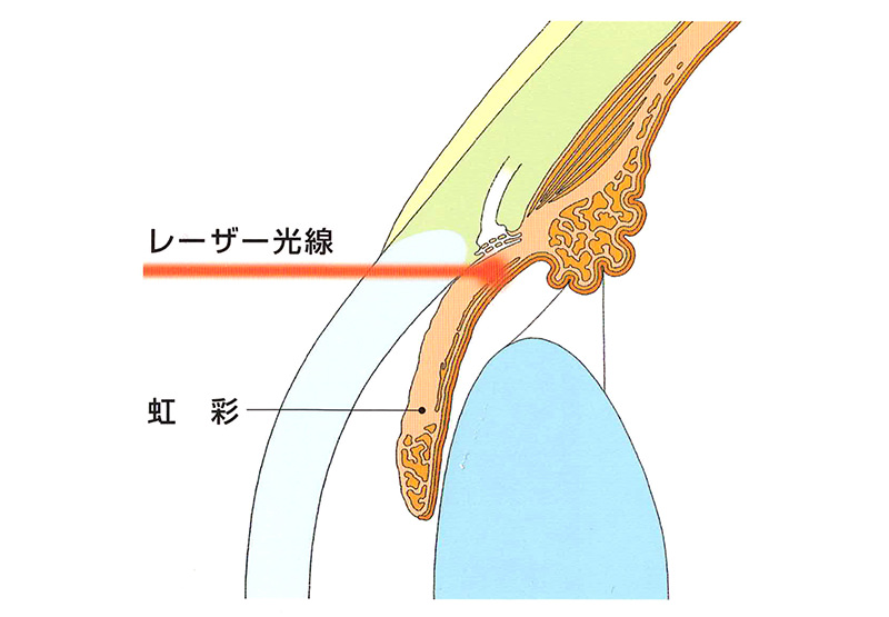 緑内障手術