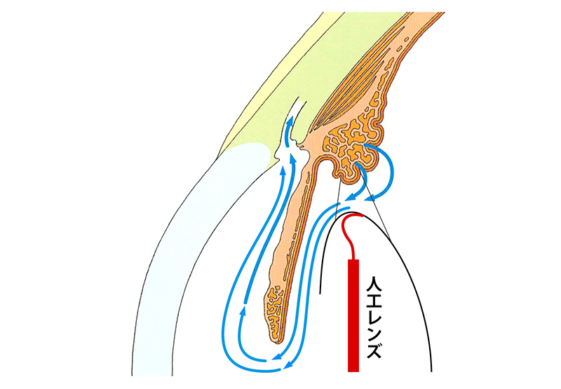 緑内障手術